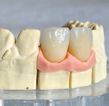 Dental Crowns | NE Calgary Dentist | Memorial Square Dental Clinic