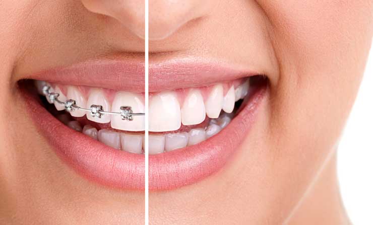 Orthodontic Dentistry | NE Calgary Dentist | Memorial Square Dental Clinic
